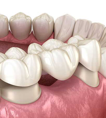 Dental Bridges in Swindon
