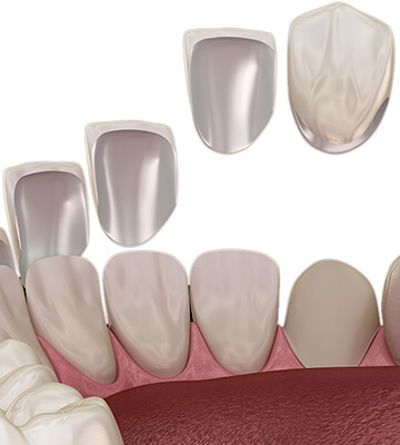 Veneers in Swindon