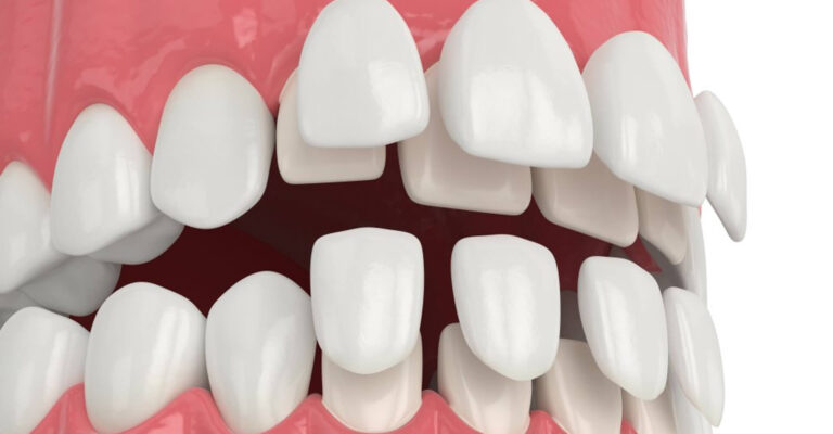 Veneers on front teeth