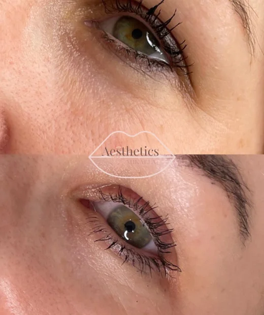Facial aesthetic treatment around the eyes