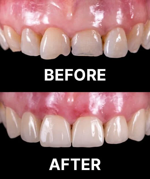 Composite bonding to repair chipped teeth