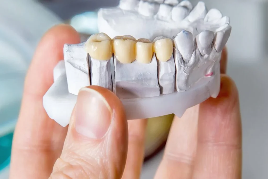 Dental bridges in Swindon